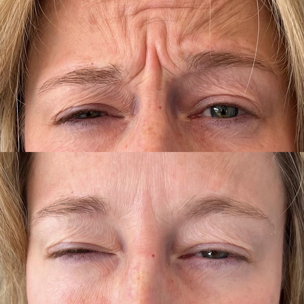 Botox Injections Phoenix