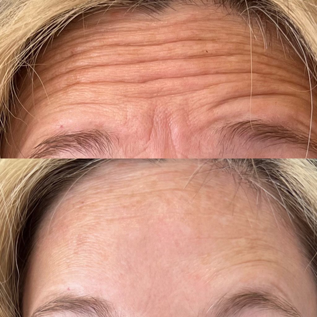 Botox Injections Phoenix