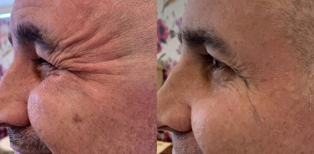 Botox Injections Phoenix