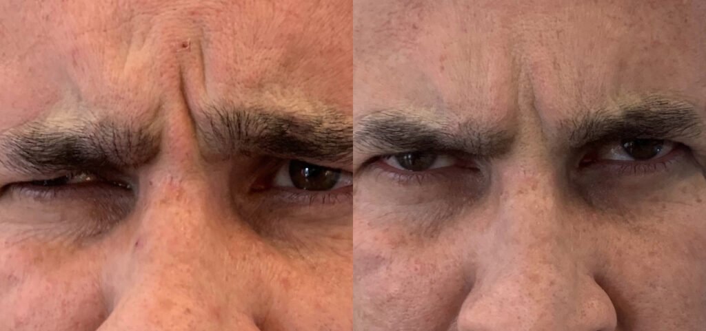 Botox Injections Phoenix