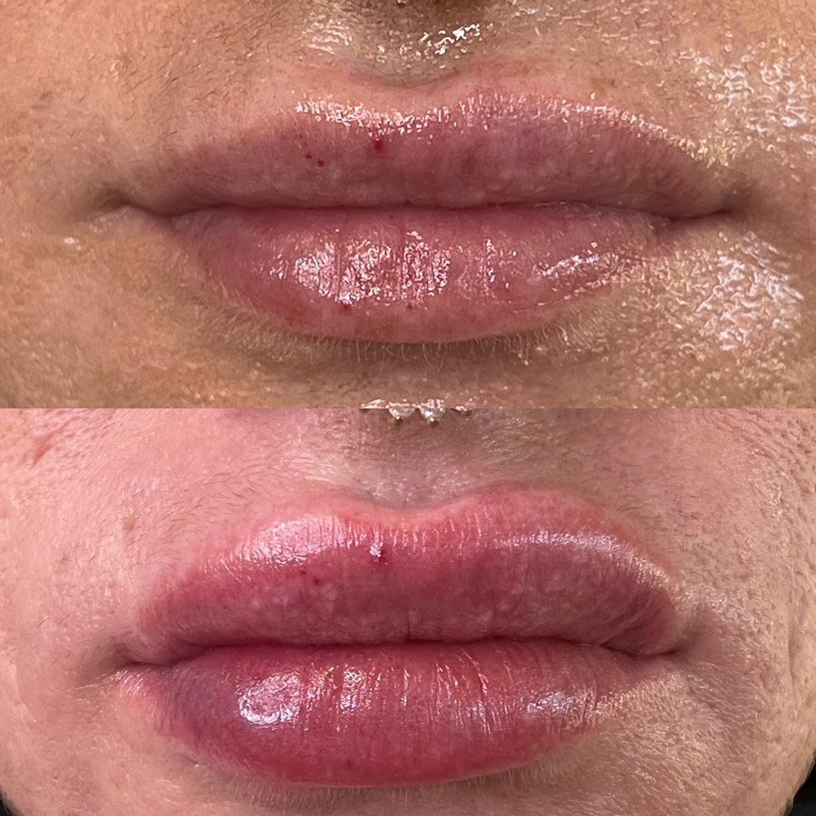 Lip Fillers Phoenix – Lip Filler & Lip Injections in Phoenix, AZ for Fuller Lips