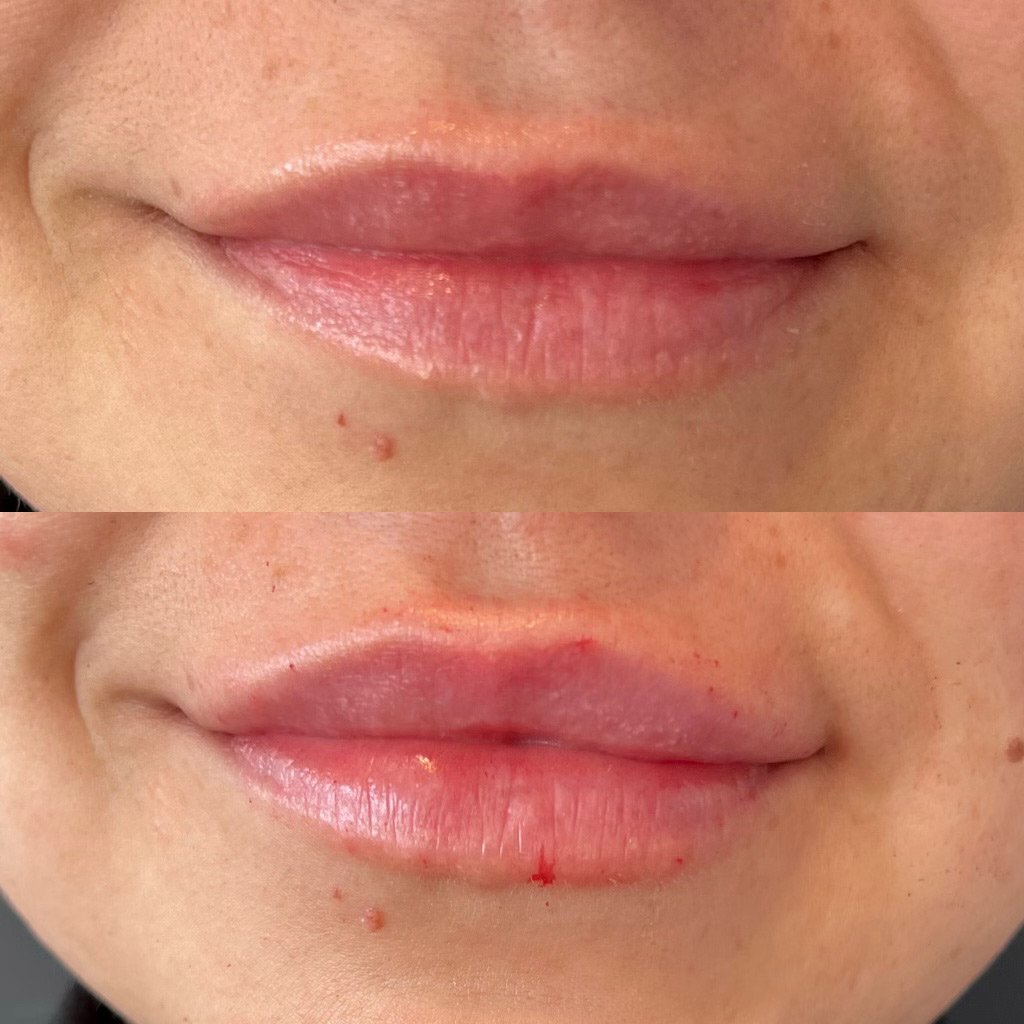 Lip Fillers Phoenix – Lip Filler & Lip Injections in Phoenix, AZ for Fuller Lips