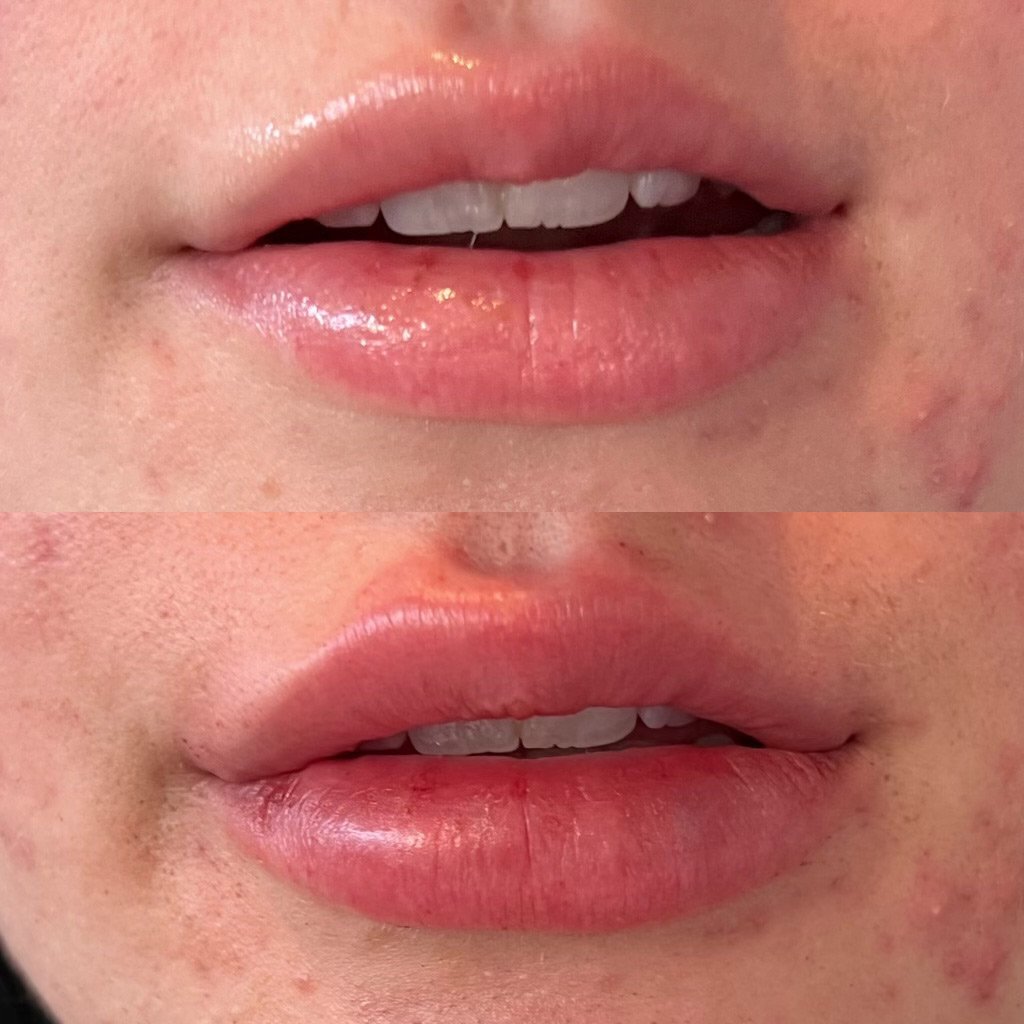Lip Fillers Phoenix – Lip Filler & Lip Injections in Phoenix, AZ for Fuller Lips