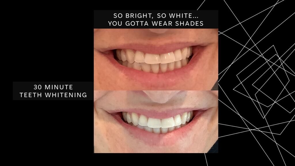 Dental Teeth Whitening Services in Phoenix – Teeth Whitening Phoenix