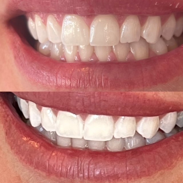 Dental Teeth Whitening Phoenix – Teeth Whitening Services in Phoenix