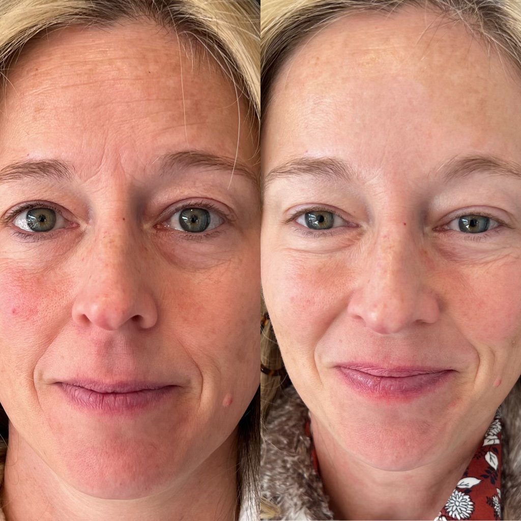 OBSOLETE Botox Injections in Phoenix AZ – Botox Phoenix Arizona Botox Services