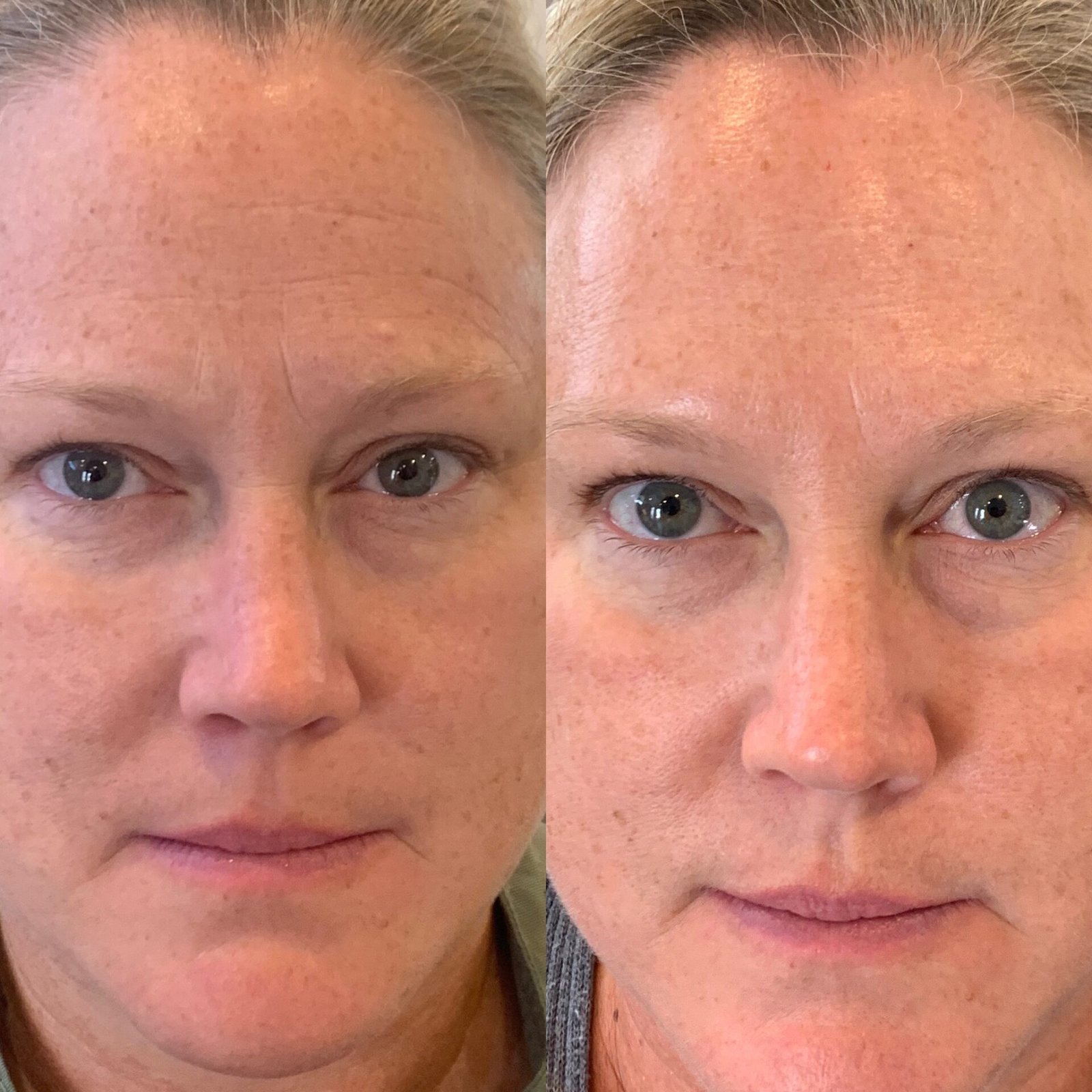OBSOLETE Botox Injections in Phoenix AZ – Botox Phoenix Arizona Botox Services