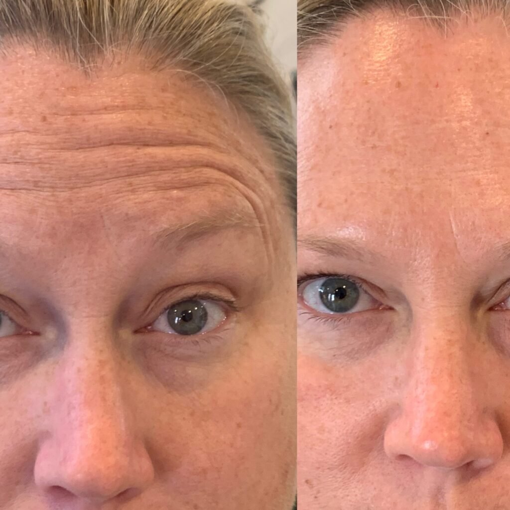 OBSOLETE Botox Injections in Phoenix AZ – Botox Phoenix Arizona Botox Services